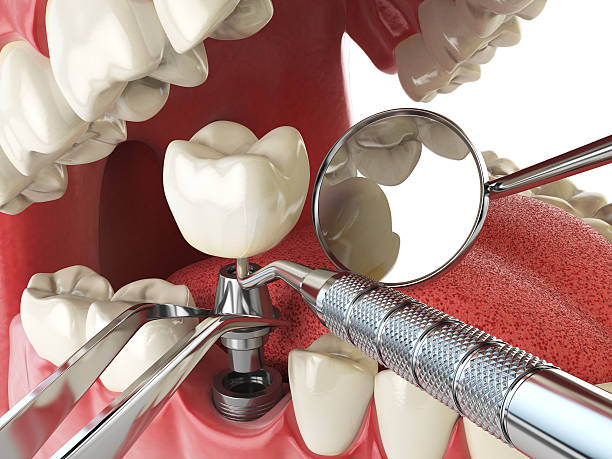 Best Emergency Root Canal Treatment in Marine, IL